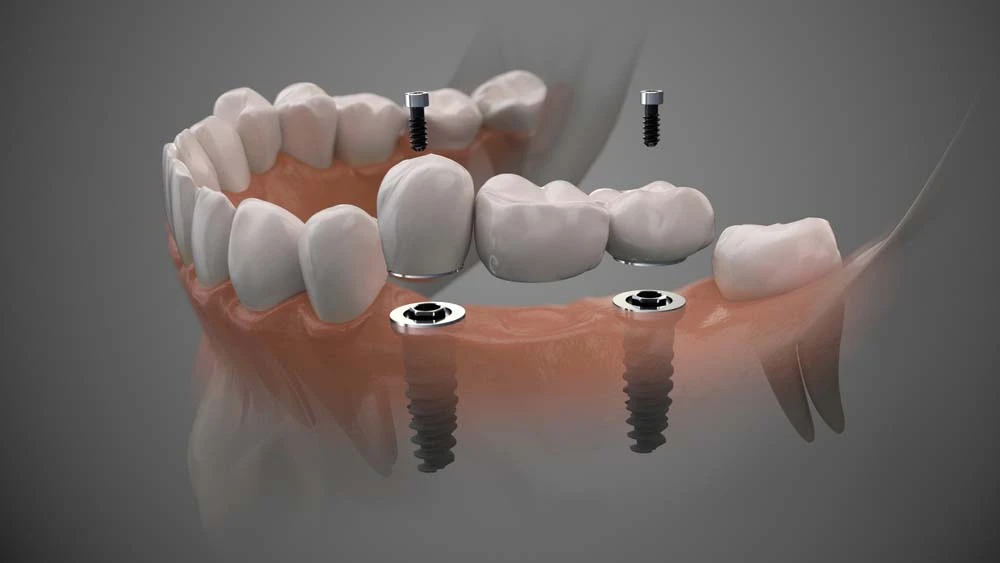 Dental Bridges