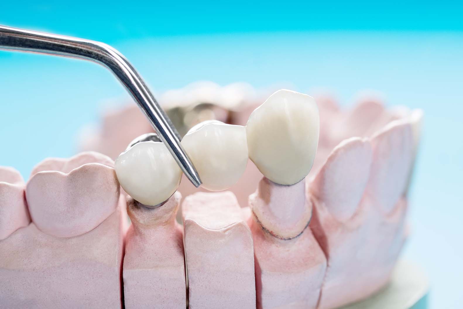 Dental Crowns and Bridges